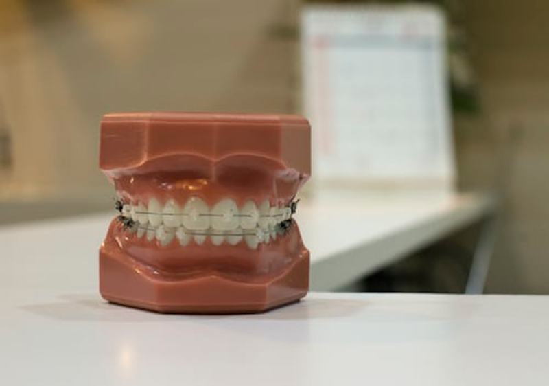 A photo of a dental model showing the placement of teeth with the use of braces.